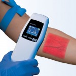 The Accuvein device depicting the visualisation of veins in the arm.